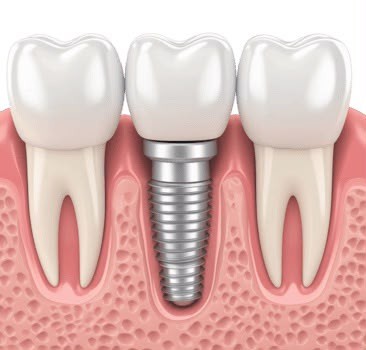 Implantes e prótese protocolo
